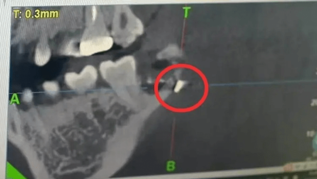 女子复诊惊见“嘴里残留手术针”。 女子复诊惊见“嘴里残留手术针”。