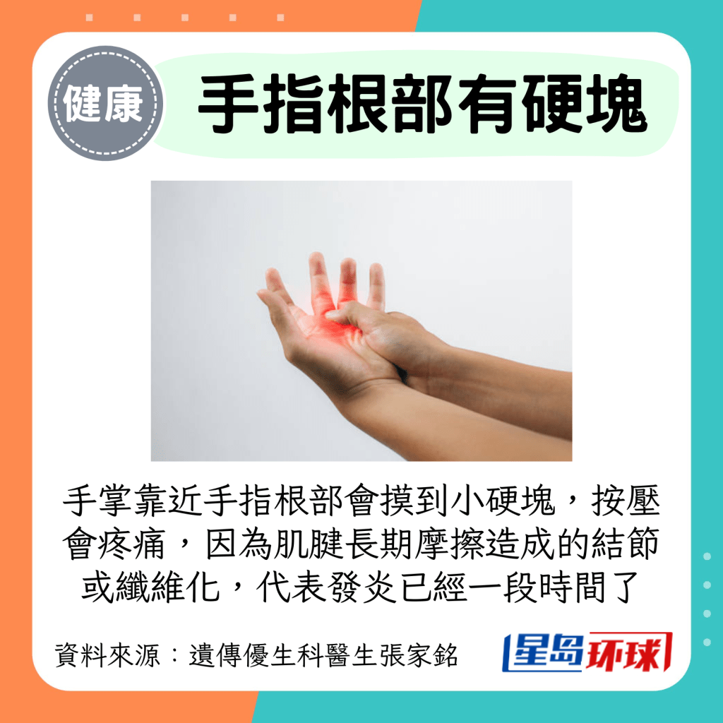 手掌靠近手指根部会摸到小硬块,按压会疼痛,因为肌腱长期摩擦造成的结节或纤维化,代表发炎已经一段时间了 手掌靠近手指根部会摸到小硬块,按压会疼痛,因为肌腱长期摩擦造成的结节或纤维化,代表发炎已经一段时间了