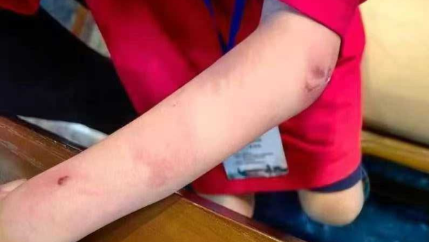 朱宏鑫曾多次被发现满身伤痕。 朱宏鑫曾多次被发现满身伤痕。