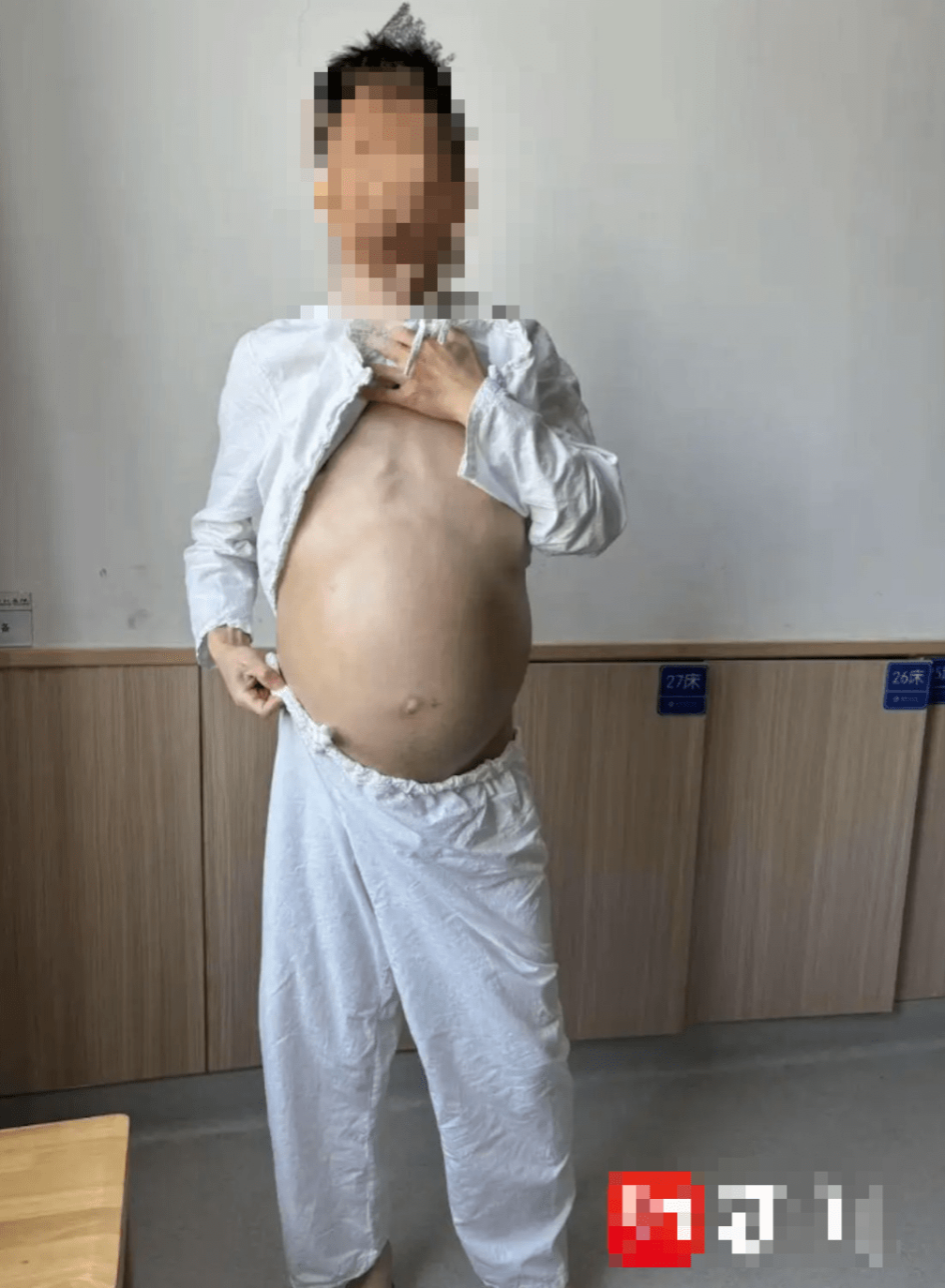 患者腹部严重膨隆,如十月怀胎孕妇。 患者腹部严重膨隆,如十月怀胎孕妇。