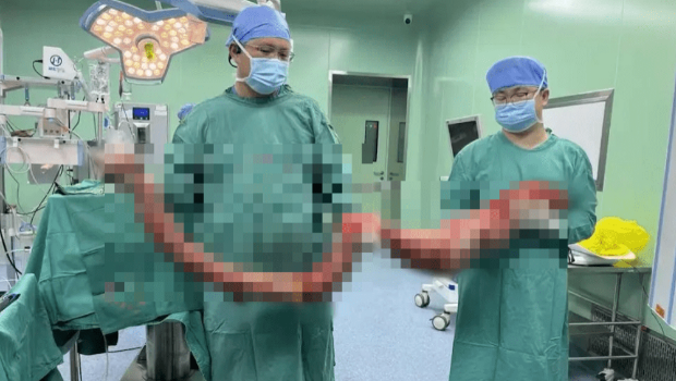 医生手术取出2米长10多公斤结肠。 医生手术取出2米长10多公斤结肠。