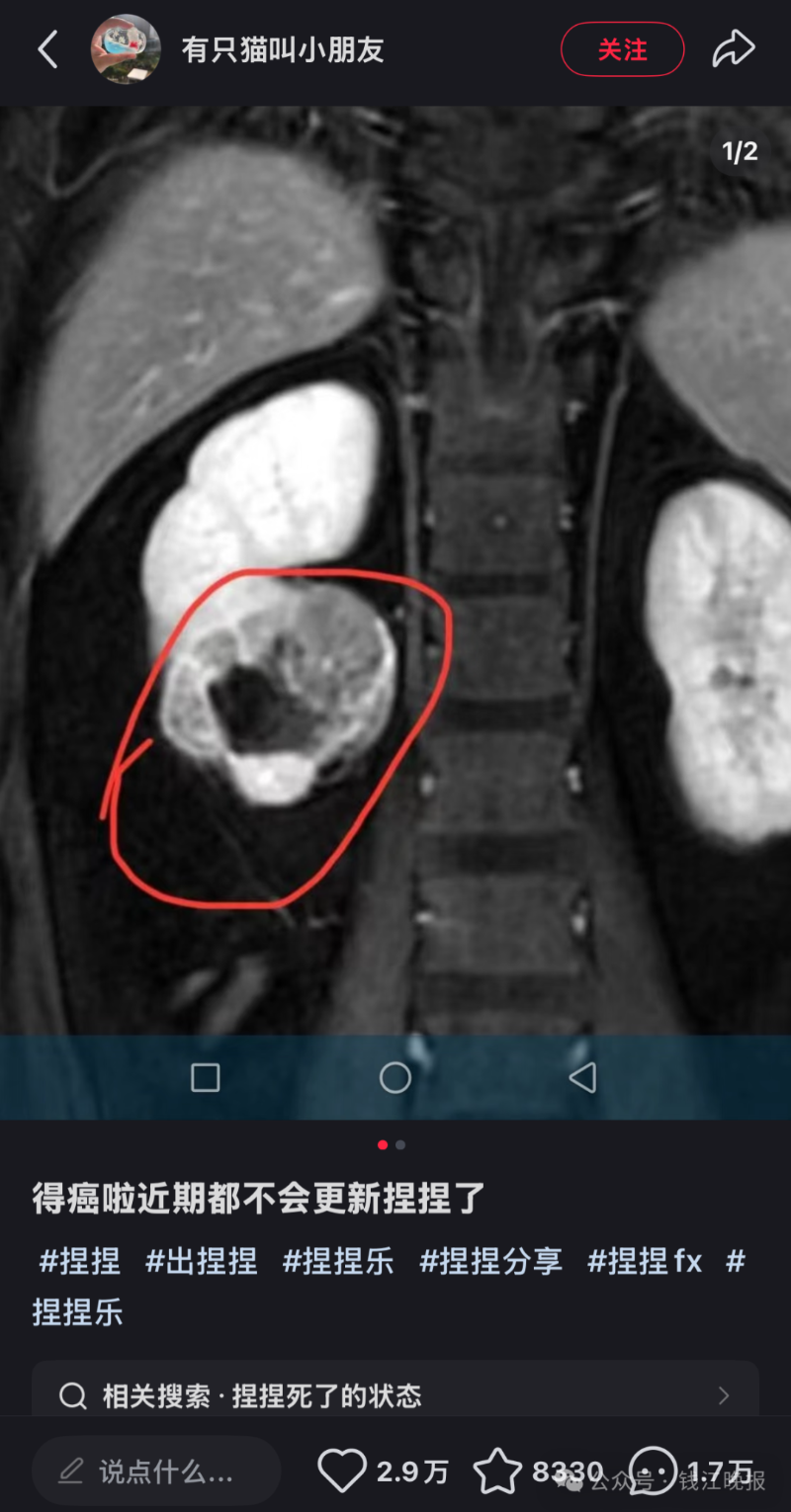 该博主在社交平台宣布罹患癌症。图源其账号截图 该博主在社交平台宣布罹患癌症。图源其账号截图