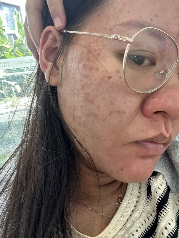 李女士怀孕期间样子及皮肤出现惊人变化。 李女士怀孕期间样子及皮肤出现惊人变化。