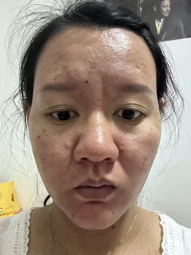 李女士怀孕期间样子及皮肤出现惊人变化。抖音@李是木子李 李女士怀孕期间样子及皮肤出现惊人变化。抖音@李是木子李