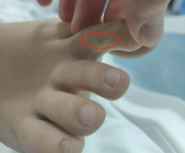 事发后,甜甜一脚趾出现点状伤口。红星新闻 事发后,甜甜一脚趾出现点状伤口。红星新闻