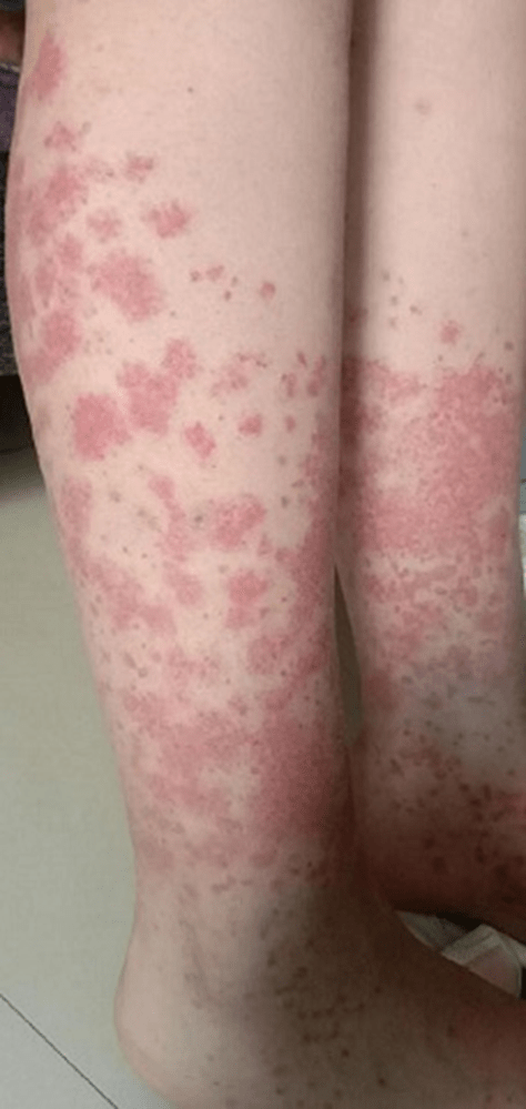 小琳的两条腿布满了对称分布的紫癜,按压后也不褪色。 小琳的两条腿布满了对称分布的紫癜,按压后也不褪色。