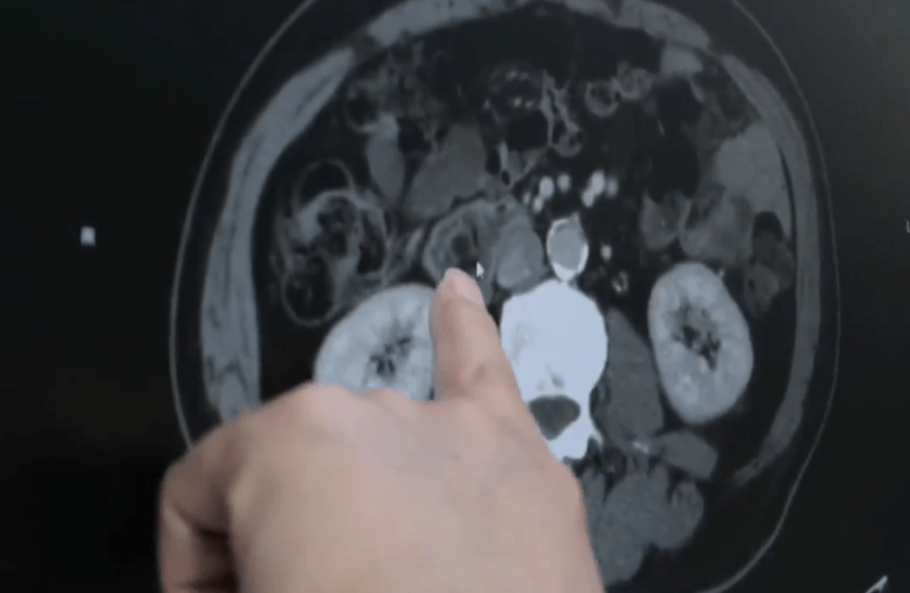 医生找出十二指肠弯曲处有异物。 医生找出十二指肠弯曲处有异物。