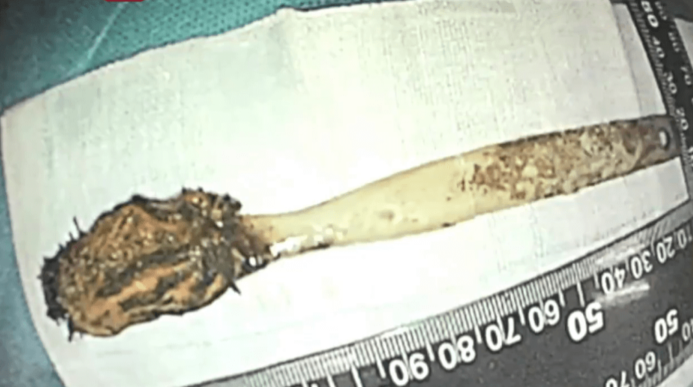 医生取出藏肠52年的“古董牙刷”。 医生取出藏肠52年的“古董牙刷”。