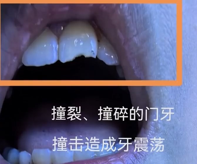 吴女士儿子事后门牙断裂。广东电视台 吴女士儿子事后门牙断裂。广东电视台