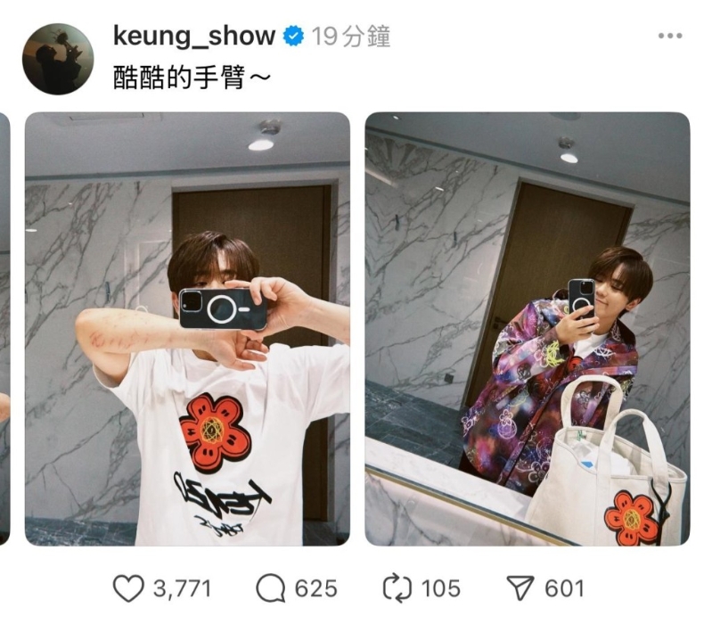 姜涛首次公开两前臂的伤势。2 姜涛首次公开两前臂的伤势。2