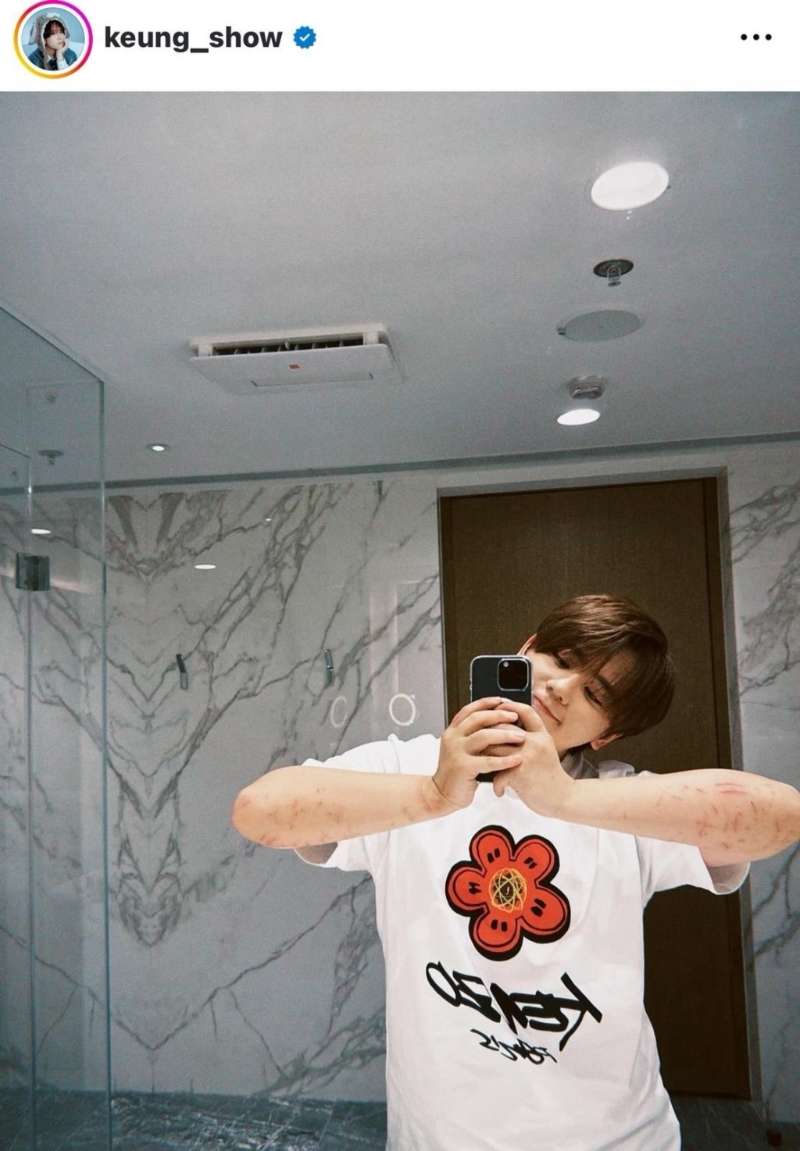 姜涛首次公开两前臂的伤势。1 姜涛首次公开两前臂的伤势。1