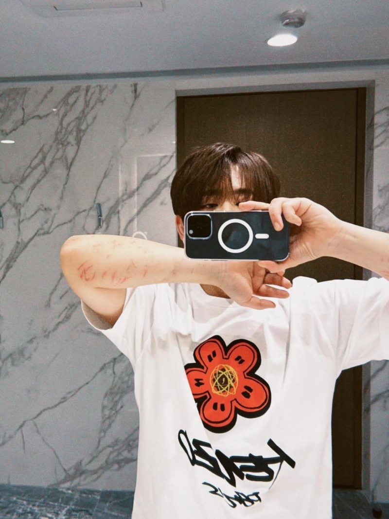 姜涛首次公开两前臂的伤势。 姜涛首次公开两前臂的伤势。