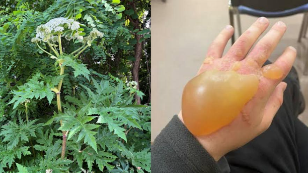 专家在社交平台上发放一张手碰到大豕草汁液后起巨大水泡的照片。 专家在社交平台上发放一张手碰到大豕草汁液后起巨大水泡的照片。