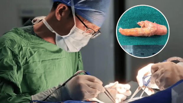 宁波5旬汉每天2包烟致“颈动脉狭窄”,颈血管取出如“凤爪”般的斑块。 宁波5旬汉每天2包烟致“颈动脉狭窄”,颈血管取出如“凤爪”般的斑块。