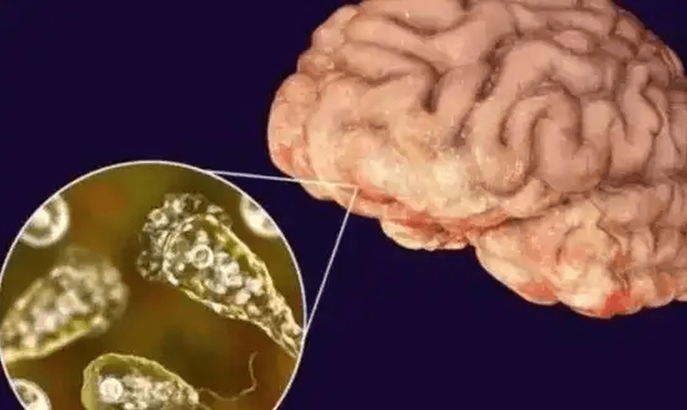 阿米巴原虫,俗称食脑虫,一旦经由鼻腔进入人体,会沿著嗅神经直接侵入大脑,引发急性阿米巴脑膜炎。 阿米巴原虫,俗称食脑虫,一旦经由鼻腔进入人体,会沿著嗅神经直接侵入大脑,引发急性阿米巴脑膜炎。