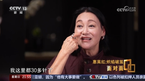 惠英红近日接受央视访问,表示脸上曾缝89针。 惠英红近日接受央视访问,表示脸上曾缝89针。