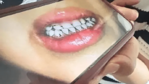 幼儿园血铅中毒事件中,幼童的牙黑成老烟民。 幼儿园血铅中毒事件中,幼童的牙黑成老烟民。