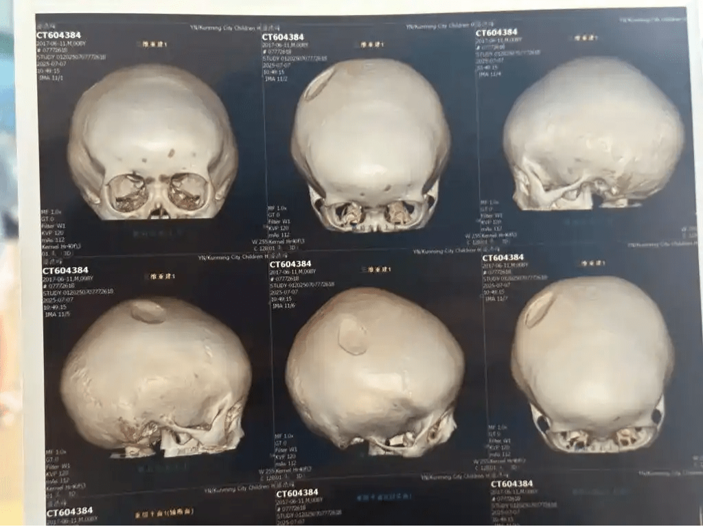 孩子头部右侧顶骨局部凹陷,最深处达0.7厘米。 孩子头部右侧顶骨局部凹陷,最深处达0.7厘米。