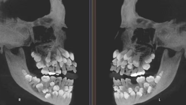 11岁女童口内惊现81颗牙 11岁女童口内惊现81颗牙