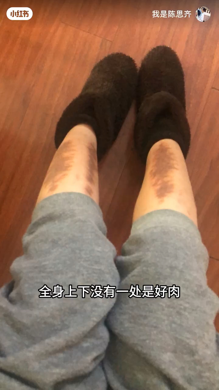 陈思齐指自己没有“没有块好肉”。 陈思齐指自己没有“没有块好肉”。