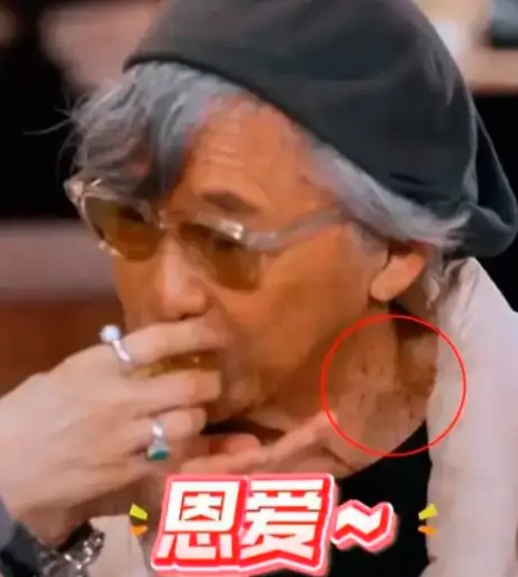 林子祥的颈上出现离奇黑斑。 林子祥的颈上出现离奇黑斑。