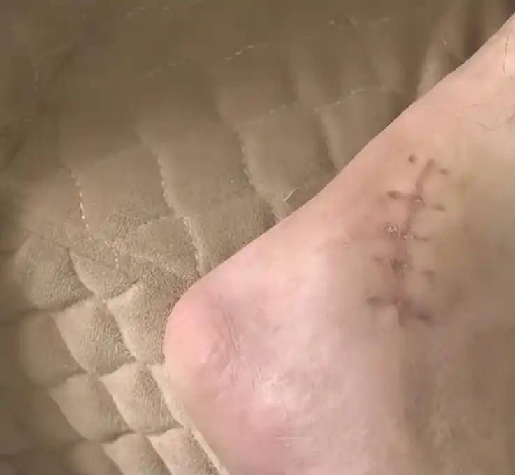 邱先生踝关节骨折。 邱先生踝关节骨折。