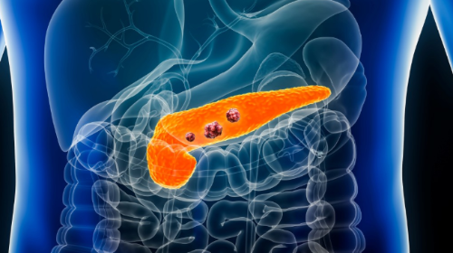 胰脏癌治疗现重大突破! 胰脏癌治疗现重大突破!