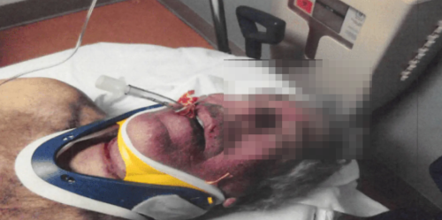 照片显示,爱泼斯坦脸部红肿,脖子上有勒痕 照片显示,爱泼斯坦脸部红肿,脖子上有勒痕