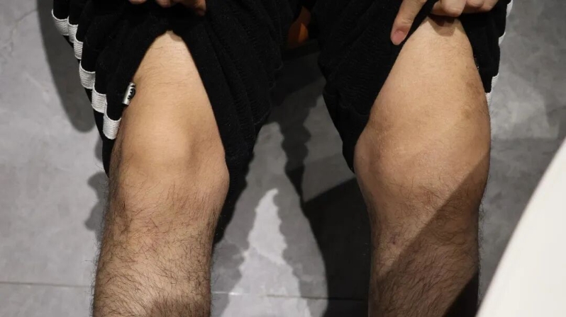 叶胜乐左腿膝盖肿胀,医生判断为出血。 叶胜乐左腿膝盖肿胀,医生判断为出血。