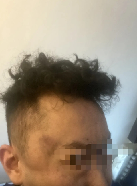 受害人孙姓男子展示伤情。 受害人孙姓男子展示伤情。