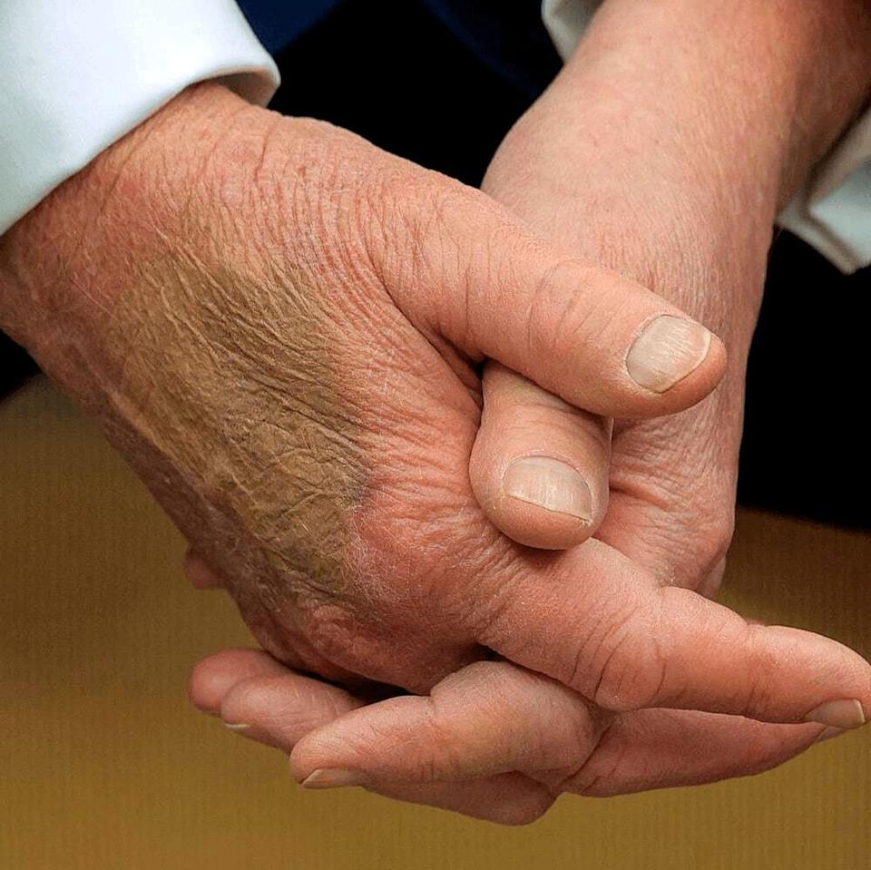 特朗普近年频频被拍到右手背出现大片瘀青,还需用粉底液遮掩。 特朗普近年频频被拍到右手背出现大片瘀青,还需用粉底液遮掩。