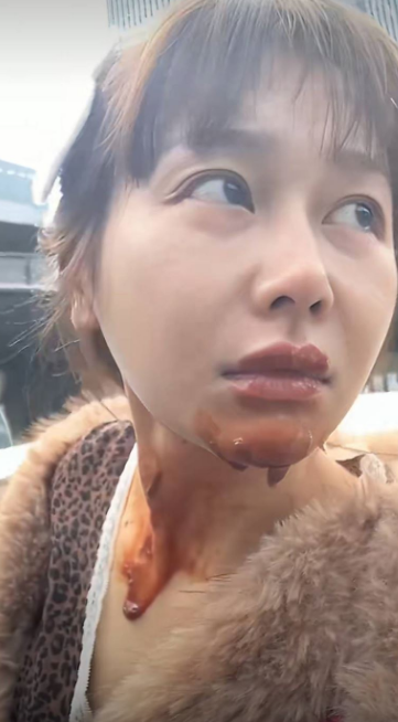 她的下巴及颈部严重烧伤,眼睫毛、眉毛及部分头发亦被烧焦 她的下巴及颈部严重烧伤,眼睫毛、眉毛及部分头发亦被烧焦